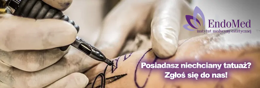 Laserowe usuwanie tatuażu Toruń
